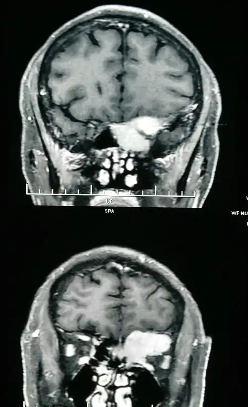 左侧前颅窝底颅眶沟通性淋巴瘤一例
