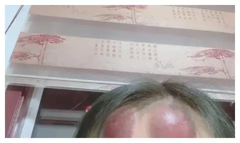 幽默笑话谁说头上拔火罐能治头疼的

