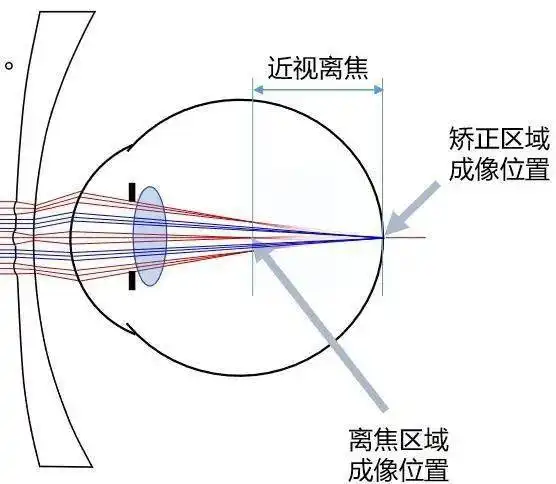 这些东西,正在悄悄夺走孩子的视力
