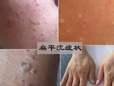 扁平疣去除用什么方法管用这些是你在医院听不到的
