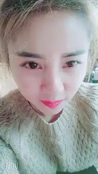 虽说现在的脸面部表情还是不能太丰富,不过跟拆线前的...全面部多部位填充悦美整形
