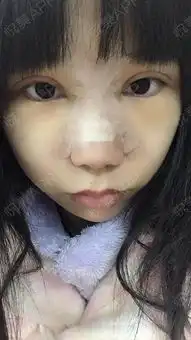 今天只把眼睛的线拆掉了拆线没我形象中的痛也没出血...隆鼻悦美整形
