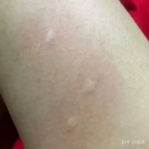 大家有被蚊子叮包后的奇葩照片吗
