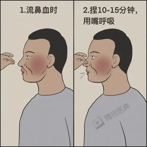 鱼刺卡喉流鼻血仰头别再这样自杀式急救了