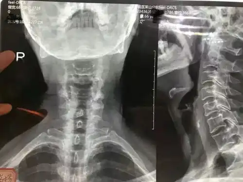太神奇了这个方法竟然治好了颈椎病高血压偏头痛等疑难杂症
