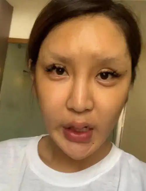 网红花86万整容失败看到她整容前的照片,网友医生真的尽力了
