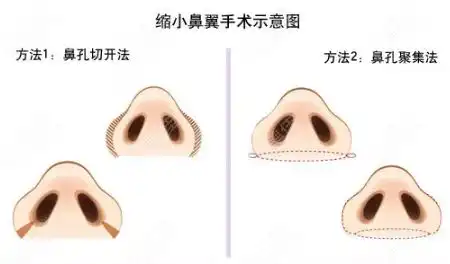 从鼻翼缩小手术内切和外切的区别来了解该怎么选择