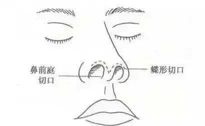 为什么隆鼻综合隆鼻你知道吗
