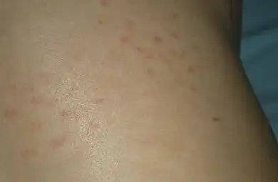 肾病红斑狼疮早期症状

