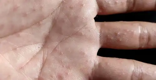奇痒无比这种夏天手上超爱长的小水泡到底怎么对付
