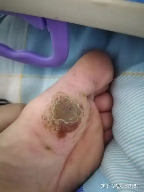 我是如何不使用冷冻治疗好跖疣的
