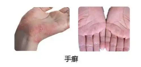手上痒痒的小水泡,很可能是这俩病

