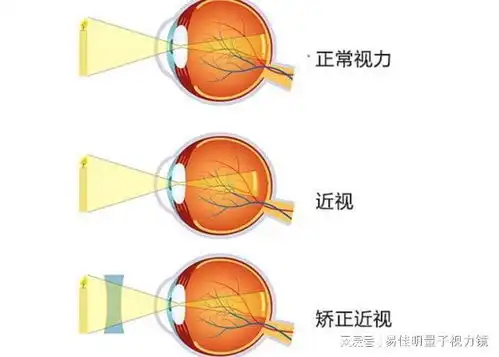 揭秘近视眼探索其原理成因与预防方法
