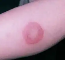 红斑狼疮的症状表现有哪些
