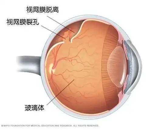28岁男性险些眼盲,这一点不做好真的很危险
