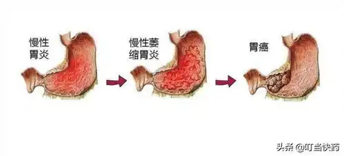 萎缩性胃炎真的是胃萎缩了看完这个事实你就明白了
