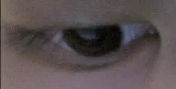 想问一下这是针眼么