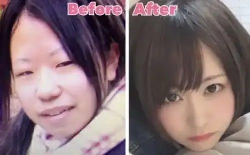 因丑被嘲笑,女子一怒之下拿400万整容,看到照片后,网友沸腾了
