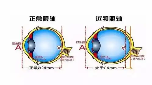 太原视康眼科重申眼轴长度是近视精准防控的金标准

