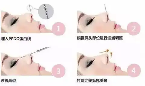 金燕子线雕隆鼻轻轻松松塑造漂亮鼻型你还在为你的鼻子而发愁吗