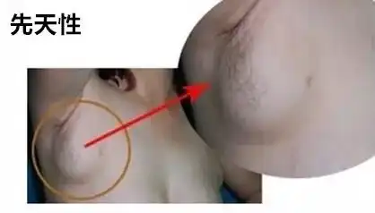 如何区分副乳和肥肉
