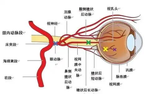 视网膜中央动脉阻塞复通,福州爱尔眼科医院实现新技术新突破
