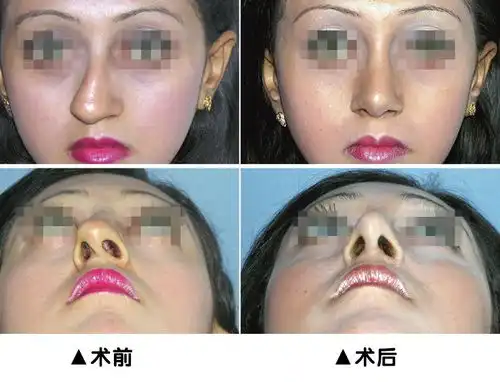 鼻子流血表情包鼻腔