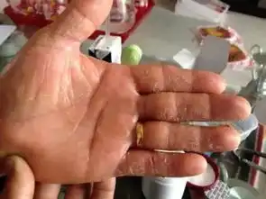 生冻疮了怎么办看这里
