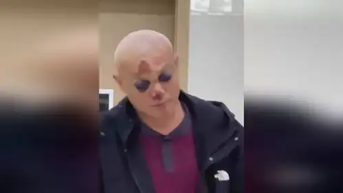 摔跤摔出一对熊猫眼,男子酒后摔跤导致颅前窝骨折
