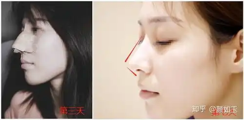 沈阳隆鼻好点的整形医院和医生推荐下
