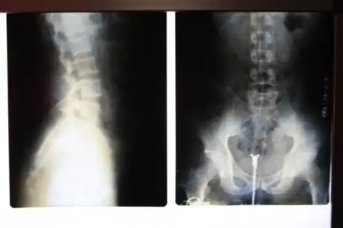 腰椎x光片ct核磁共振,啥区别,看这里全搞明白
