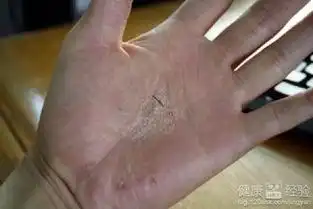 汗疱疹用什么药治疗可以根治
