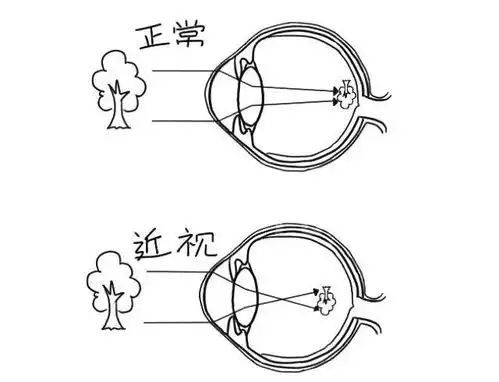 近视远视散光是啥样的看完这些图分分钟搞懂
