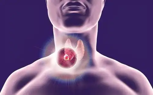 知名男星患甲状腺癌上热搜近年来发病率逐渐上升
