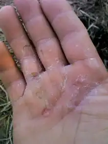 我手被脚气感染了总是痒得很,还掉皮,就是这样,大家看看有什么办法可以治疗
